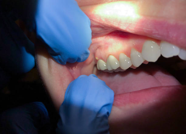 Best Emergency Dental Filling Replacement  in Beckley, WV