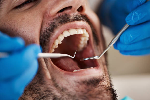 Best Chipped Tooth Repair Near Me  in Beckley, WV